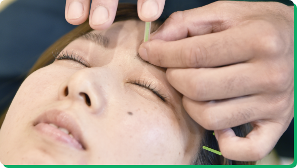 美容鍼の施術を受ける女性の様子