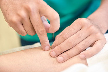 鍼治療の施術を受ける女性の様子