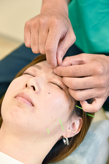 美容鍼を受ける女性の施術風景